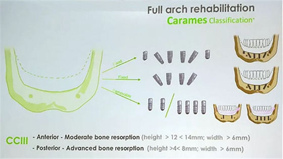 【熱點(diǎn)回顧】帶您深度了解無牙頜種植修復(fù)——Pro Arch 【熱點(diǎn)回顧】帶您深度了解無牙頜種植修復(fù)——Pro Arch