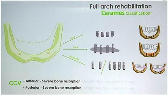 【熱點(diǎn)回顧】帶您深度了解無牙頜種植修復(fù)——Pro Arch 【熱點(diǎn)回顧】帶您深度了解無牙頜種植修復(fù)——Pro Arch