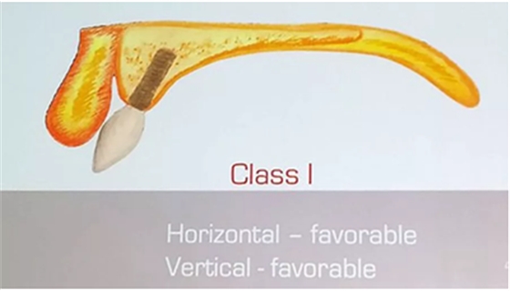 【熱點(diǎn)回顧】帶您深度了解無牙頜種植修復(fù)——Pro Arch 【熱點(diǎn)回顧】帶您深度了解無牙頜種植修復(fù)——Pro Arch