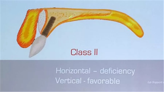 【熱點(diǎn)回顧】帶您深度了解無牙頜種植修復(fù)——Pro Arch 【熱點(diǎn)回顧】帶您深度了解無牙頜種植修復(fù)——Pro Arch