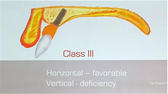 【熱點(diǎn)回顧】帶您深度了解無牙頜種植修復(fù)——Pro Arch 【熱點(diǎn)回顧】帶您深度了解無牙頜種植修復(fù)——Pro Arch