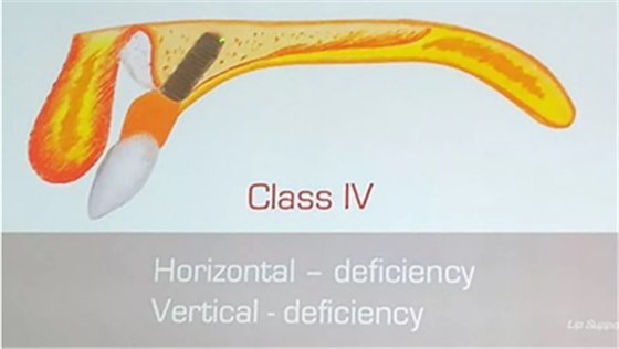 【熱點(diǎn)回顧】帶您深度了解無牙頜種植修復(fù)——Pro Arch 【熱點(diǎn)回顧】帶您深度了解無牙頜種植修復(fù)——Pro Arch