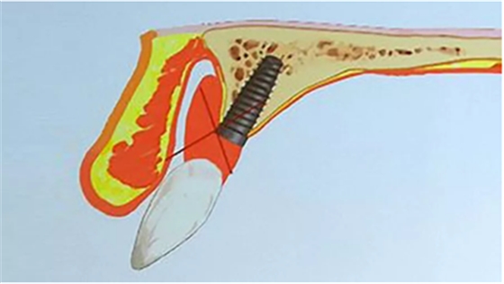 【熱點(diǎn)回顧】帶您深度了解無牙頜種植修復(fù)——Pro Arch 【熱點(diǎn)回顧】帶您深度了解無牙頜種植修復(fù)——Pro Arch