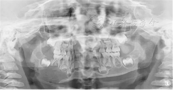 【繼續(xù)教育園地】血液系統(tǒng)及骨骼系統(tǒng)疾病在兒童口腔中的表現(xiàn) 【繼續(xù)教育園地】血液系統(tǒng)及骨骼系統(tǒng)疾病在兒童口腔中的表現(xiàn)