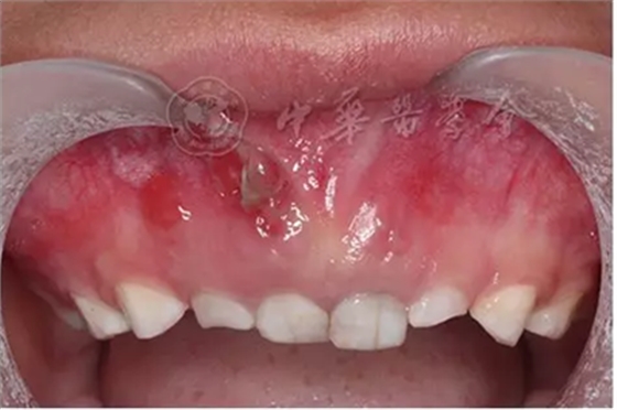 【繼續(xù)教育園地】血液系統(tǒng)及骨骼系統(tǒng)疾病在兒童口腔中的表現(xiàn) 【繼續(xù)教育園地】血液系統(tǒng)及骨骼系統(tǒng)疾病在兒童口腔中的表現(xiàn)