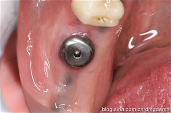 德國DMG哈尼格二代加聚硅橡膠Heavy種植印模病例展示 Part 1 德國DMG哈尼格二代加聚硅橡膠Heavy種植印模病例展示 Part 1