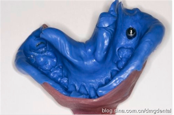 德國DMG哈尼格二代加聚硅橡膠Heavy種植印模病例展示 Part 1 德國DMG哈尼格二代加聚硅橡膠Heavy種植印模病例展示 Part 1