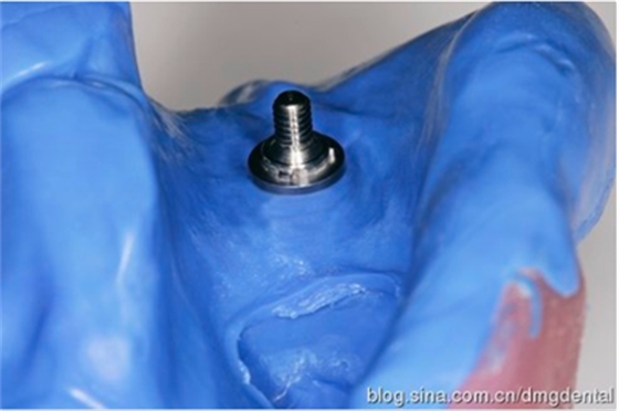 德國DMG哈尼格二代加聚硅橡膠Heavy種植印模病例展示 Part 1 德國DMG哈尼格二代加聚硅橡膠Heavy種植印模病例展示 Part 1