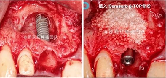 「科普篇」你真的了解它嗎？——β-磷酸三鈣
