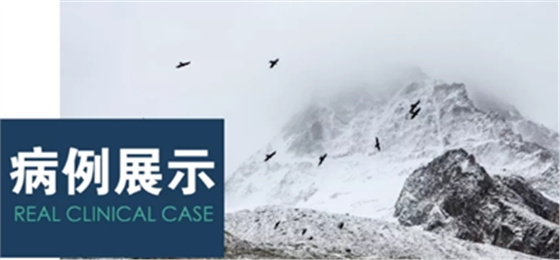 病例賞析 | 上頜竇外提升長期成骨觀察 病例賞析 | 上頜竇外提升長期成骨觀察