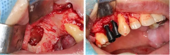 病例賞析 | 上頜竇外提升長期成骨觀察 病例賞析 | 上頜竇外提升長期成骨觀察