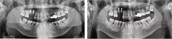 病例賞析 | 上頜竇外提升長期成骨觀察 病例賞析 | 上頜竇外提升長期成骨觀察