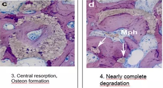 病例賞析 | 上頜竇外提升長期成骨觀察 病例賞析 | 上頜竇外提升長期成骨觀察