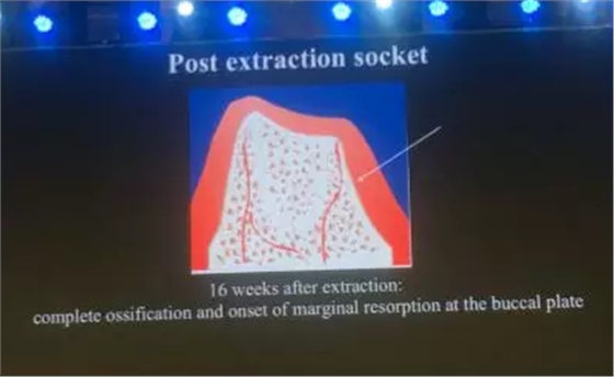【聽課筆記】拔牙后位點(diǎn)的軟硬組織處理 【聽課筆記】拔牙后位點(diǎn)的軟硬組織處理