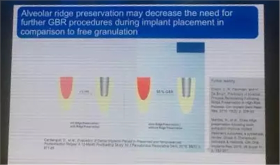 【聽課筆記】拔牙后位點(diǎn)的軟硬組織處理 【聽課筆記】拔牙后位點(diǎn)的軟硬組織處理