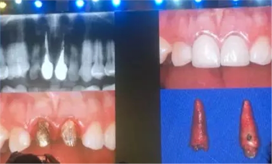 【聽課筆記】拔牙后位點(diǎn)的軟硬組織處理 【聽課筆記】拔牙后位點(diǎn)的軟硬組織處理