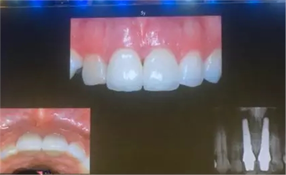 【聽課筆記】拔牙后位點(diǎn)的軟硬組織處理 【聽課筆記】拔牙后位點(diǎn)的軟硬組織處理