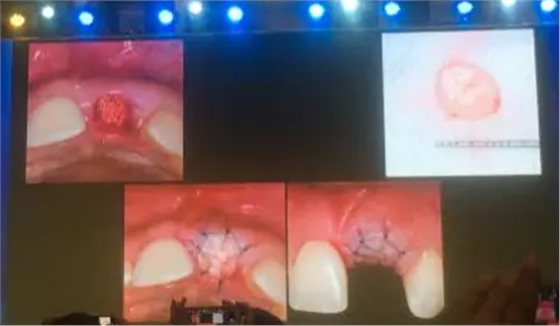 【聽課筆記】拔牙后位點(diǎn)的軟硬組織處理 【聽課筆記】拔牙后位點(diǎn)的軟硬組織處理