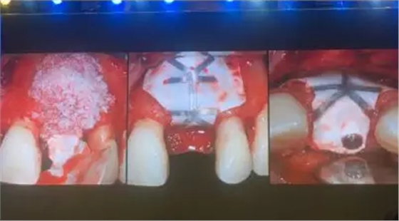 【聽課筆記】拔牙后位點(diǎn)的軟硬組織處理 【聽課筆記】拔牙后位點(diǎn)的軟硬組織處理