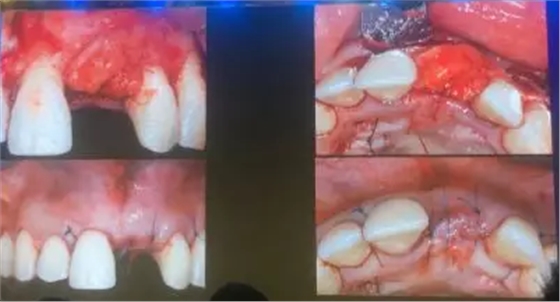 【聽課筆記】拔牙后位點(diǎn)的軟硬組織處理 【聽課筆記】拔牙后位點(diǎn)的軟硬組織處理