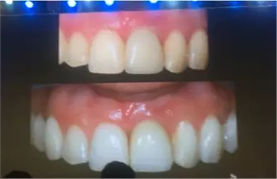 【聽課筆記】拔牙后位點(diǎn)的軟硬組織處理 【聽課筆記】拔牙后位點(diǎn)的軟硬組織處理