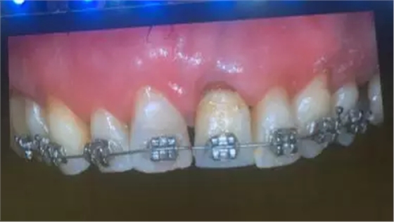 【聽課筆記】拔牙后位點(diǎn)的軟硬組織處理 【聽課筆記】拔牙后位點(diǎn)的軟硬組織處理