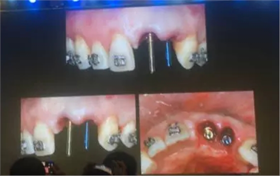 【聽課筆記】拔牙后位點(diǎn)的軟硬組織處理 【聽課筆記】拔牙后位點(diǎn)的軟硬組織處理