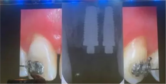 【聽課筆記】拔牙后位點(diǎn)的軟硬組織處理 【聽課筆記】拔牙后位點(diǎn)的軟硬組織處理