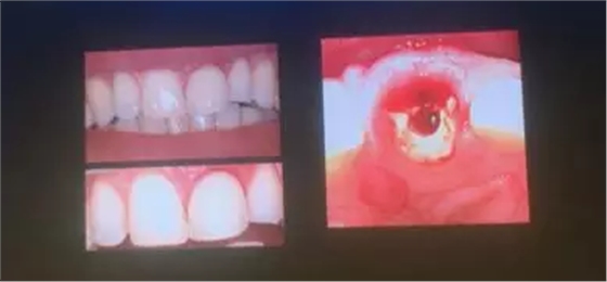 【聽課筆記】拔牙后位點(diǎn)的軟硬組織處理 【聽課筆記】拔牙后位點(diǎn)的軟硬組織處理
