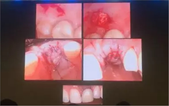 【聽課筆記】拔牙后位點(diǎn)的軟硬組織處理 【聽課筆記】拔牙后位點(diǎn)的軟硬組織處理