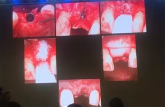 【聽課筆記】拔牙后位點(diǎn)的軟硬組織處理 【聽課筆記】拔牙后位點(diǎn)的軟硬組織處理