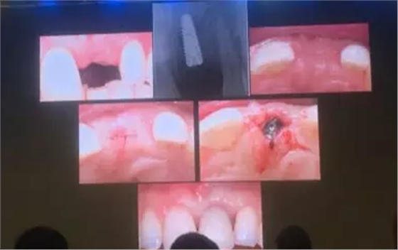 【聽課筆記】拔牙后位點(diǎn)的軟硬組織處理 【聽課筆記】拔牙后位點(diǎn)的軟硬組織處理