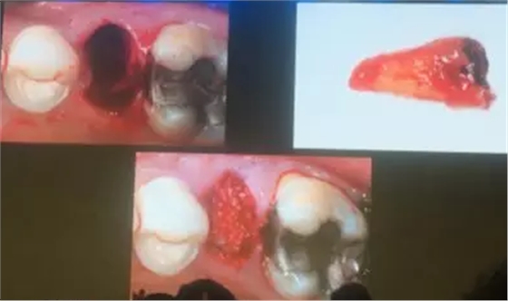 【聽課筆記】拔牙后位點(diǎn)的軟硬組織處理 【聽課筆記】拔牙后位點(diǎn)的軟硬組織處理