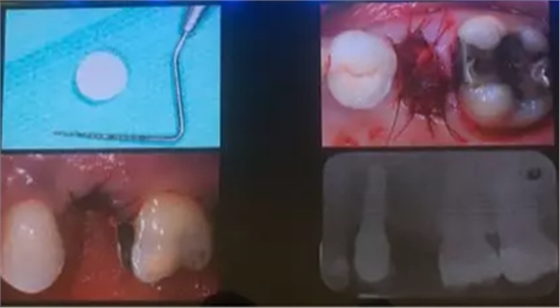 【聽課筆記】拔牙后位點(diǎn)的軟硬組織處理 【聽課筆記】拔牙后位點(diǎn)的軟硬組織處理