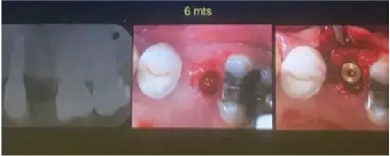 【聽課筆記】拔牙后位點(diǎn)的軟硬組織處理 【聽課筆記】拔牙后位點(diǎn)的軟硬組織處理