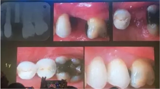 【聽課筆記】拔牙后位點(diǎn)的軟硬組織處理 【聽課筆記】拔牙后位點(diǎn)的軟硬組織處理