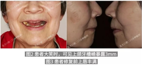 病例報道│全程數(shù)字化輔助無牙頜種植即刻負重