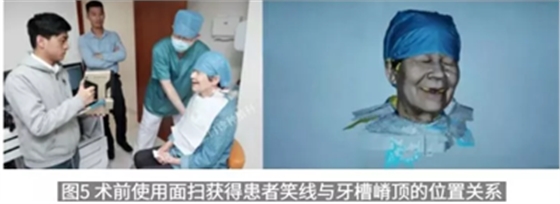 病例報道│全程數(shù)字化輔助無牙頜種植即刻負重