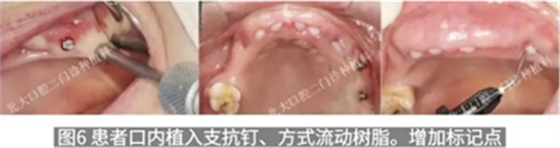 病例報道│全程數(shù)字化輔助無牙頜種植即刻負重
