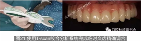 病例報道│全程數(shù)字化輔助無牙頜種植即刻負重