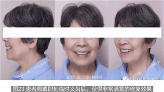 病例報道│全程數(shù)字化輔助無牙頜種植即刻負重