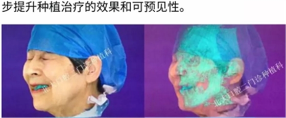 病例報道│全程數(shù)字化輔助無牙頜種植即刻負重