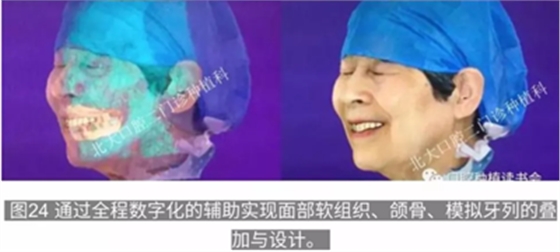 病例報道│全程數(shù)字化輔助無牙頜種植即刻負重