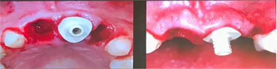 【聽課筆記】種植體周圍軟硬組織相關(guān)美學(xué)考量因素 【聽課筆記】種植體周圍軟硬組織相關(guān)美學(xué)考量因素