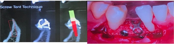【聽課筆記】種植體周圍軟硬組織相關(guān)美學(xué)考量因素 【聽課筆記】種植體周圍軟硬組織相關(guān)美學(xué)考量因素