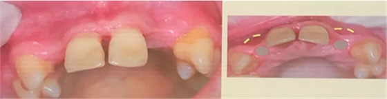 【聽課筆記】種植體周圍軟硬組織相關(guān)美學(xué)考量因素 【聽課筆記】種植體周圍軟硬組織相關(guān)美學(xué)考量因素