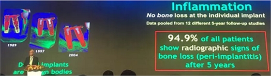 【聽(tīng)課筆記】種植體周圍骨吸收因素研究與臨床意義 【聽(tīng)課筆記】種植體周圍骨吸收因素研究與臨床意義