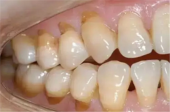 今天開始不要再這樣刷牙了，你的牙齒快被刷掉了！