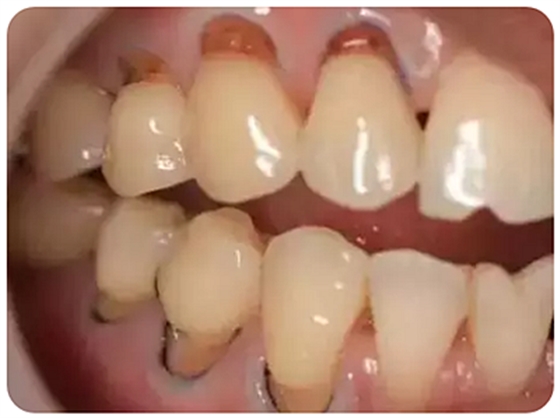 今天開始不要再這樣刷牙了，你的牙齒快被刷掉了！