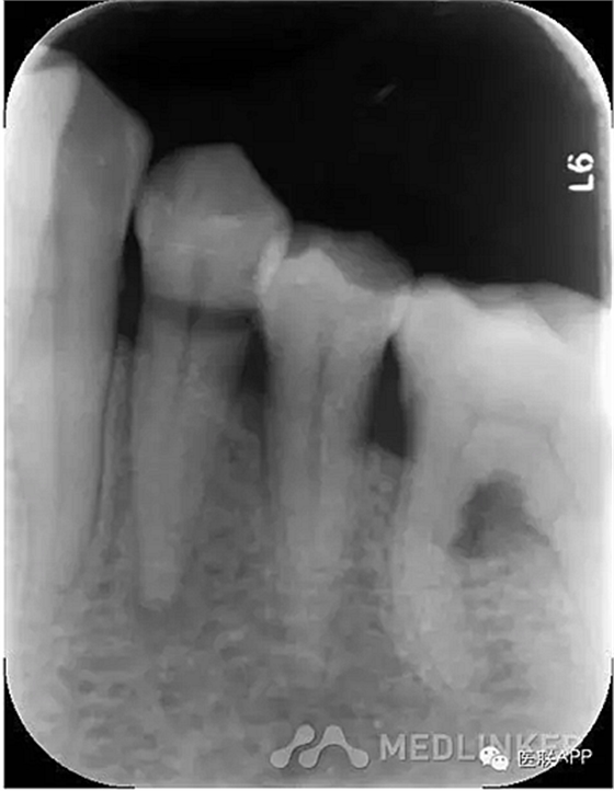 楔狀缺損導致根尖周炎 楔狀缺損導致根尖周炎